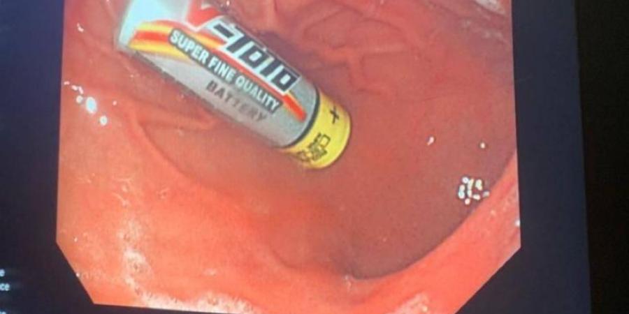 فريق طبي بمكة ينجح في إنقاذ حياة طفل ابتلع بطارية حارقة 